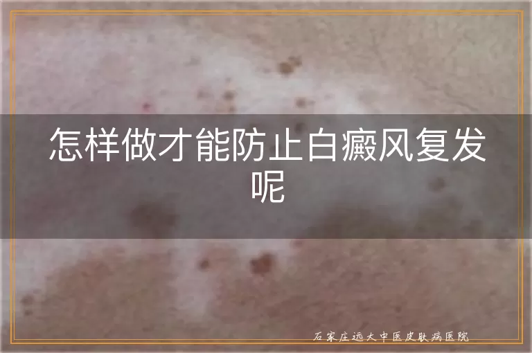 怎样做才能防止白癜风复发呢