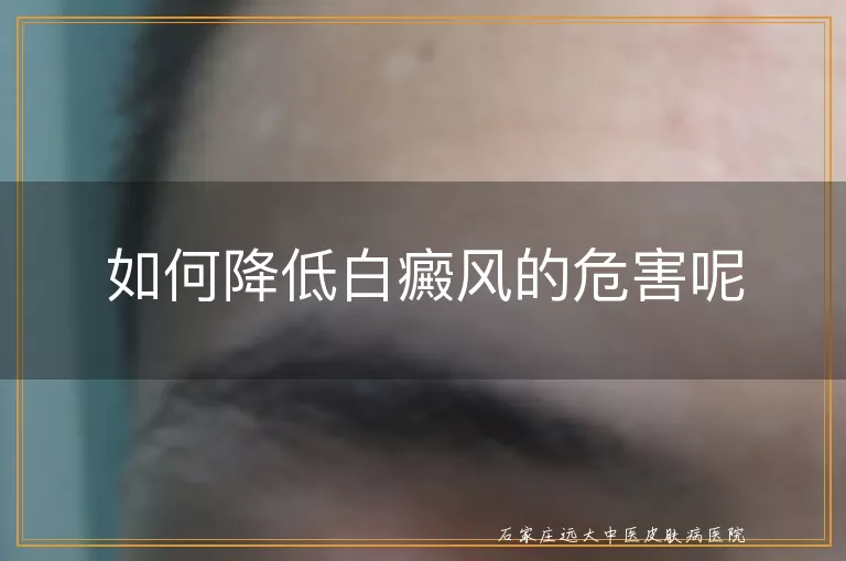 如何降低白癜风的危害呢