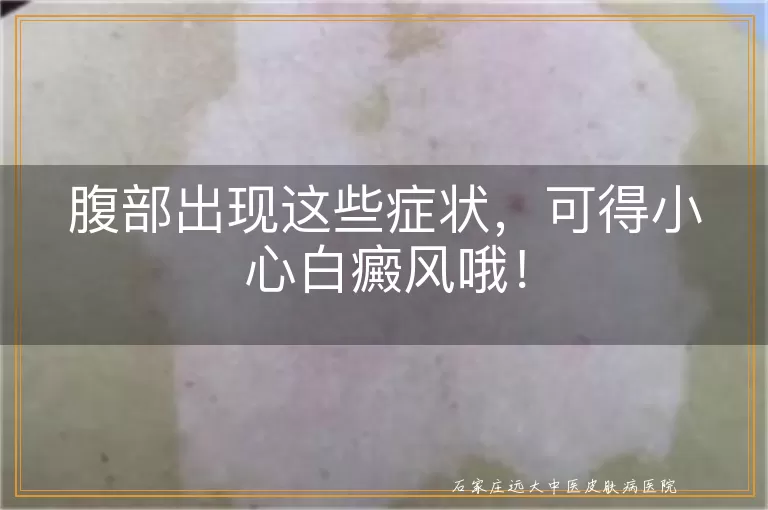 腹部出现这些症状，可得小心白癜风哦！