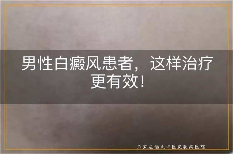 男性白癜风患者，这样治疗更有效！
