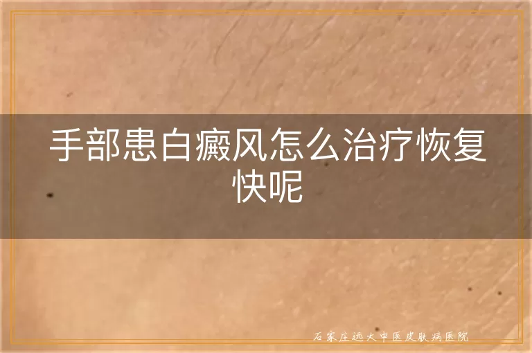 手部患白癜风怎么治疗恢复快呢