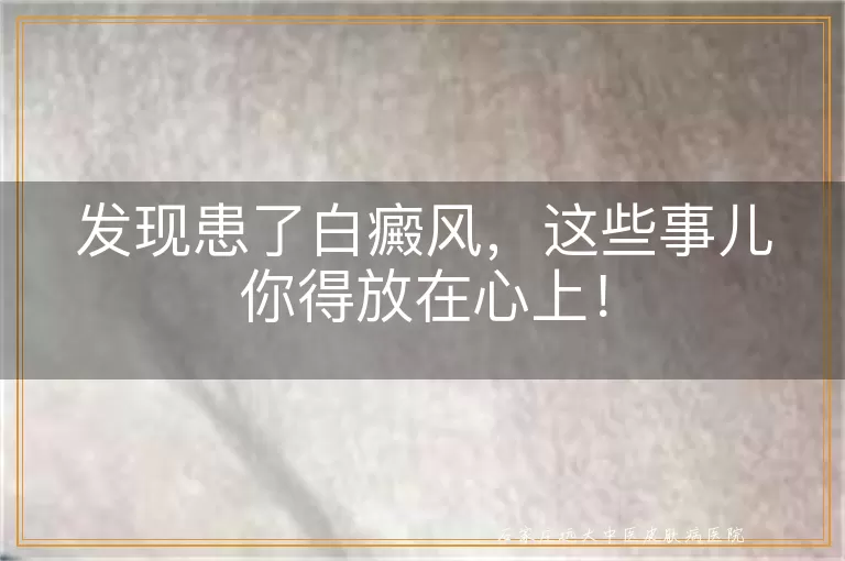 发现患了白癜风，这些事儿你得放在心上！