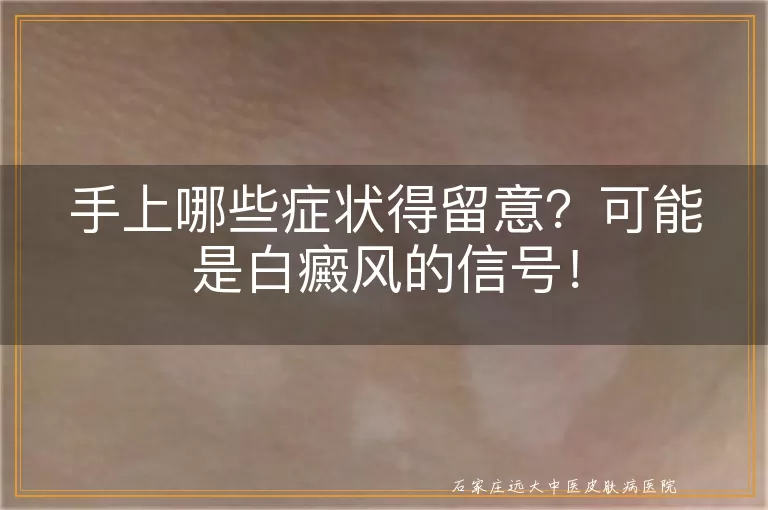 手上哪些症状得留意？可能是白癜风的信号！
