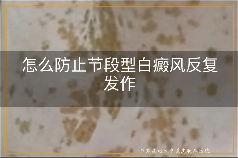 怎么防止节段型白癜风反复发作