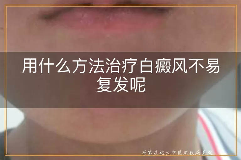 用什么方法治疗白癜风不易复发呢