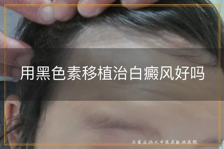 用黑色素移植治白癜风好吗