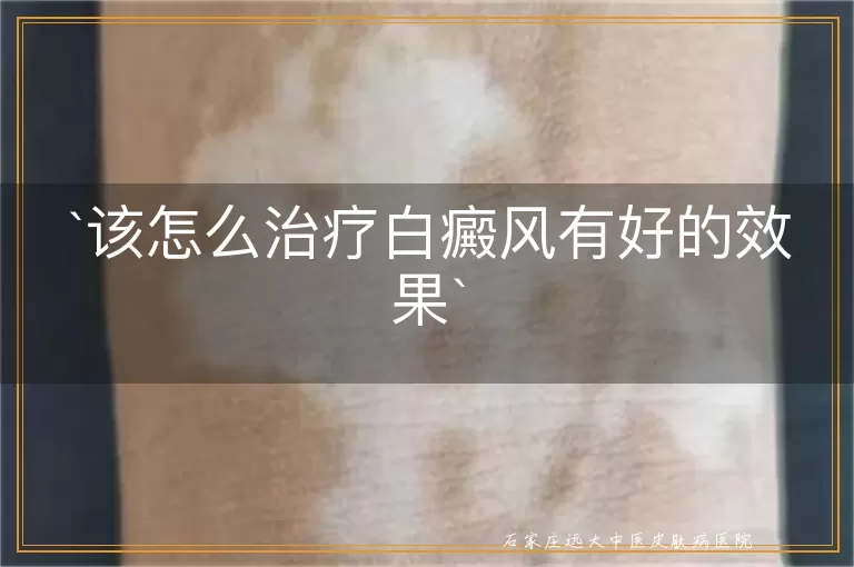 该怎么治疗白癜风有好的效果