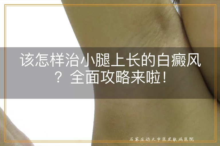 该怎样治小腿上长的白癜风？全面攻略来啦！