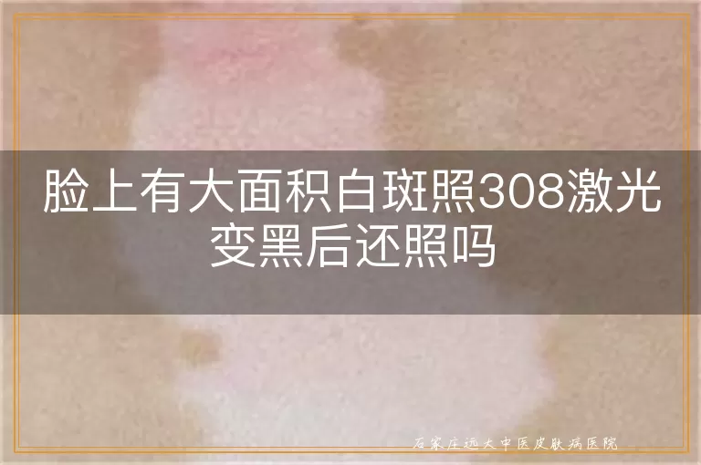 脸上有大面积白斑照308激光变黑后还照吗