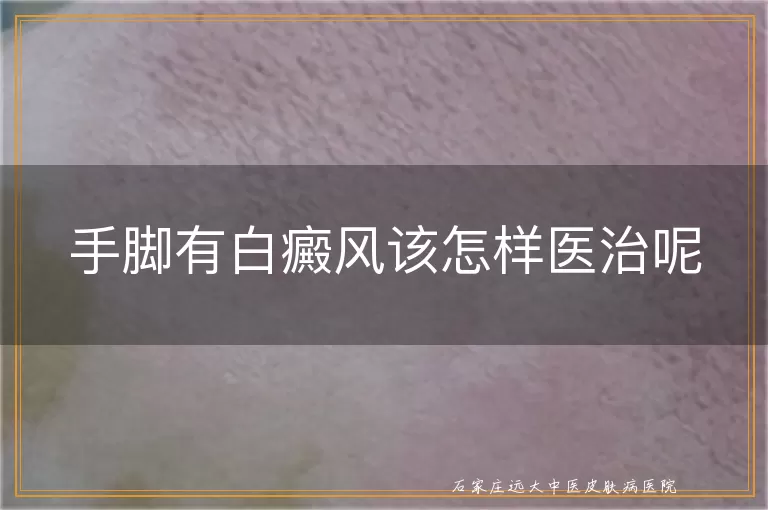 手脚有白癜风该怎样医治呢