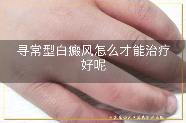 寻常型白癜风怎么才能治疗好呢