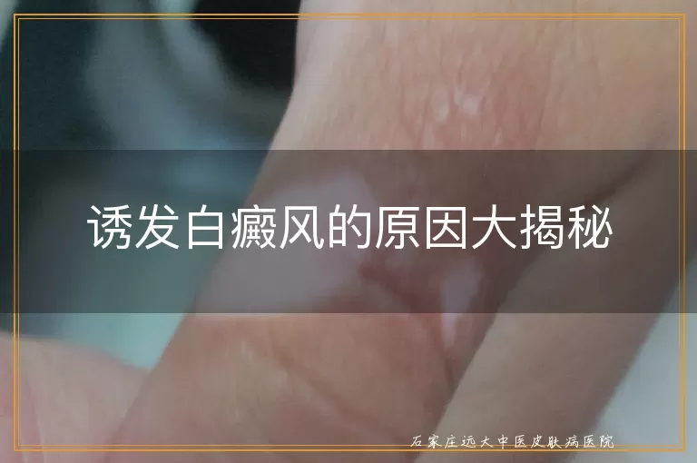 诱发白癜风的原因大揭秘