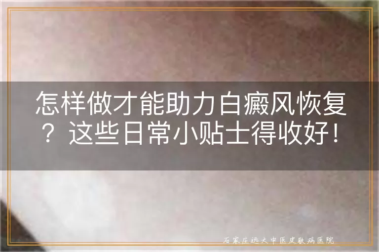 怎样做才能助力白癜风恢复？这些日常小贴士得收好！