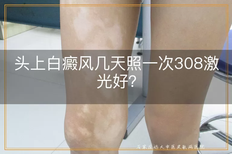 头上白癜风几天照一次308激光好？