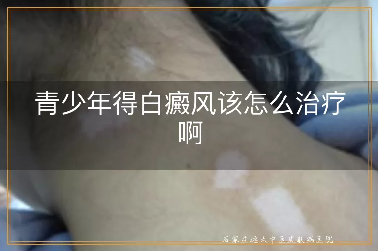 青少年得白癜风该怎么治疗啊