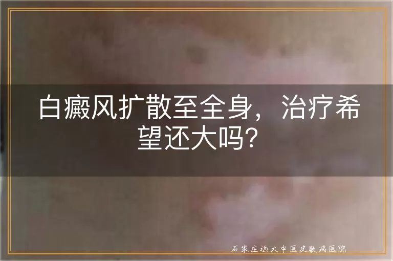 白癜风扩散至全身，治疗希望还大吗？