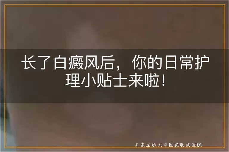 长了白癜风后，你的日常护理小贴士来啦！