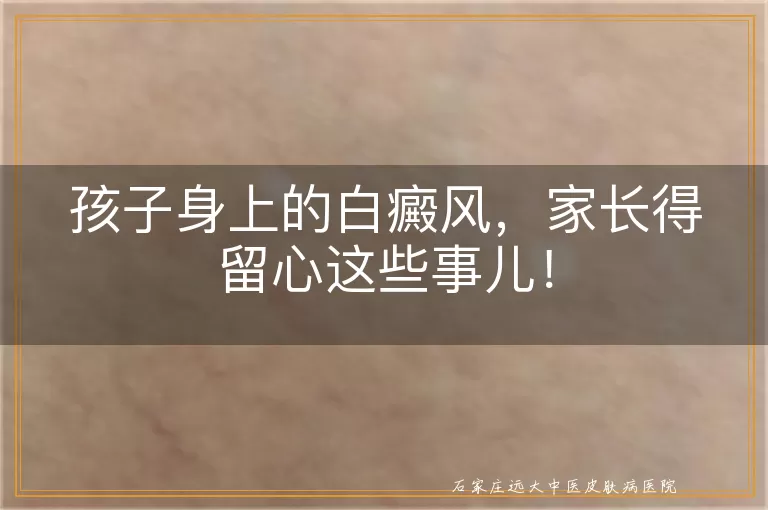 孩子身上的白癜风，家长得留心这些事儿！