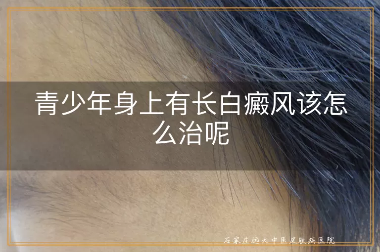 青少年身上有长白癜风该怎么治呢