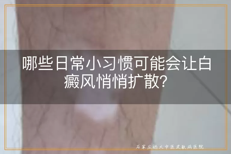 哪些日常小习惯可能会让白癜风悄悄扩散？