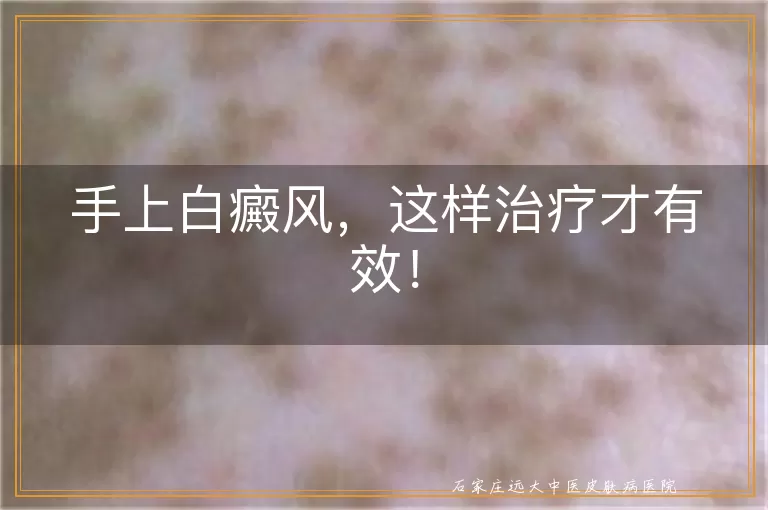 手上白癜风，这样治疗才有效！