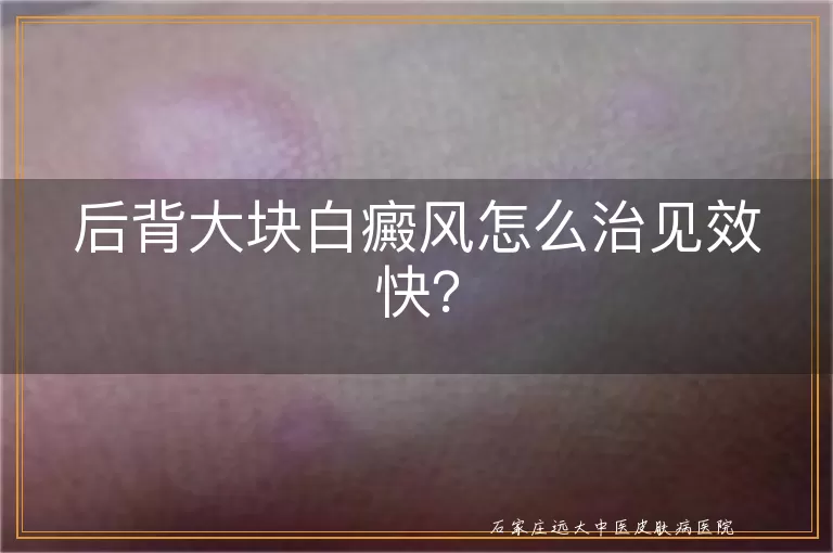 后背大块白癜风怎么治见效快？