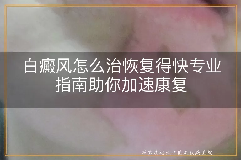 白癜风怎么治恢复得快专业指南助你加速康复