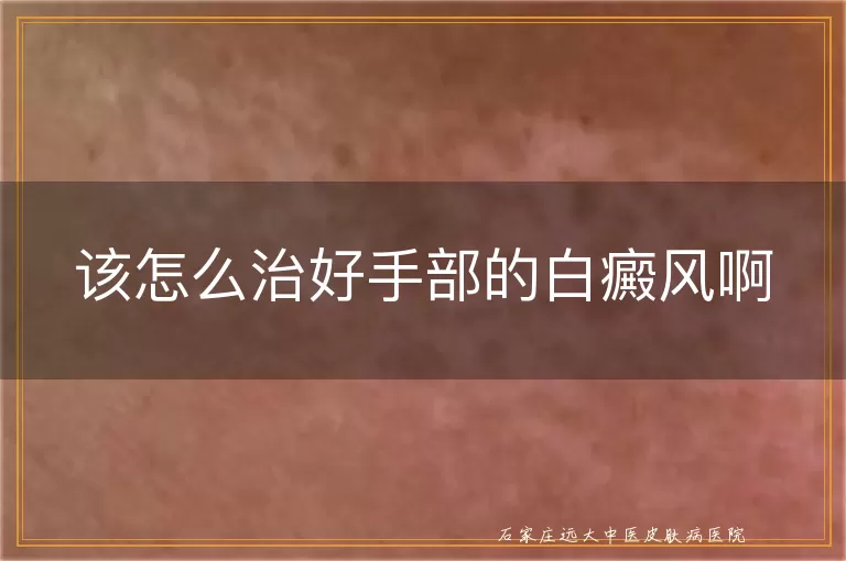 该怎么治好手部的白癜风啊