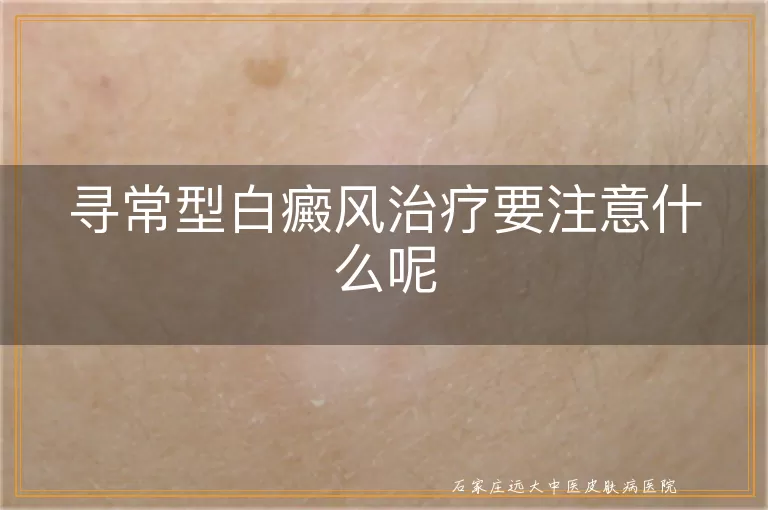 寻常型白癜风治疗要注意什么呢