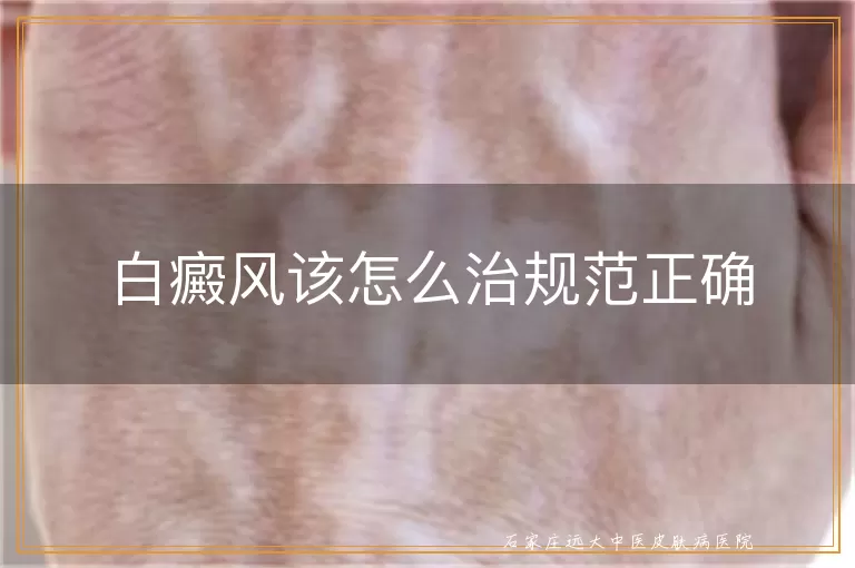 白癜风该怎么治规范正确