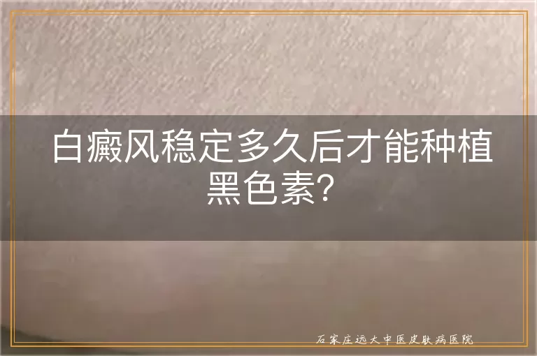 白癜风稳定多久后才能种植黑色素？