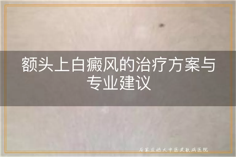 额头上白癜风的治疗方案与专业建议