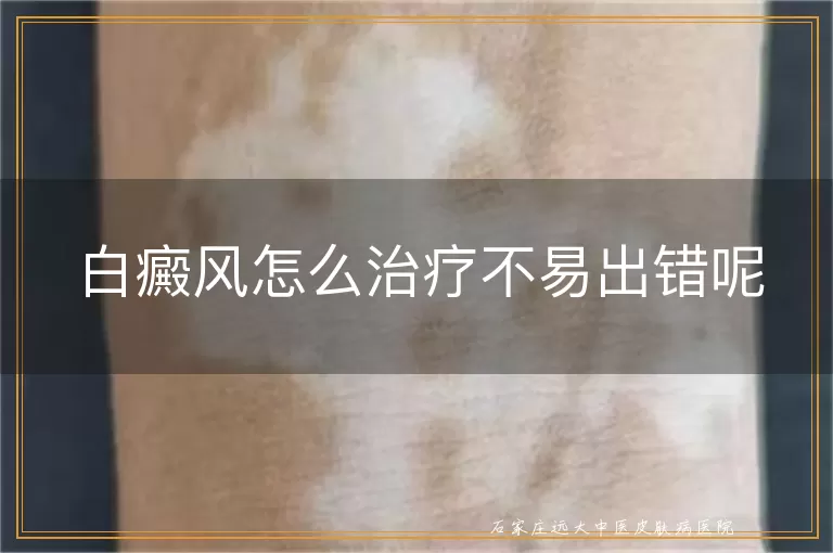 白癜风怎么治疗不易出错呢