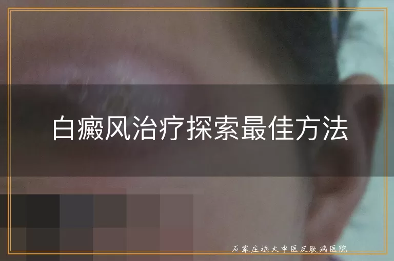 白癜风治疗探索最佳方法