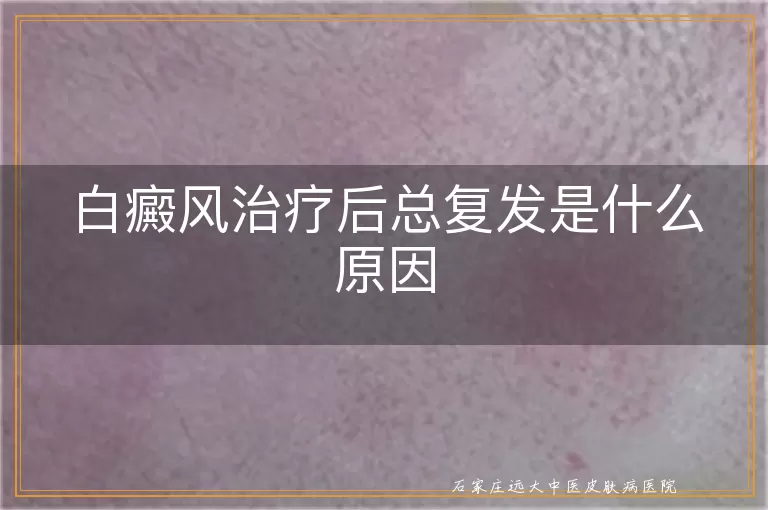 白癜风治疗后总复发是什么原因