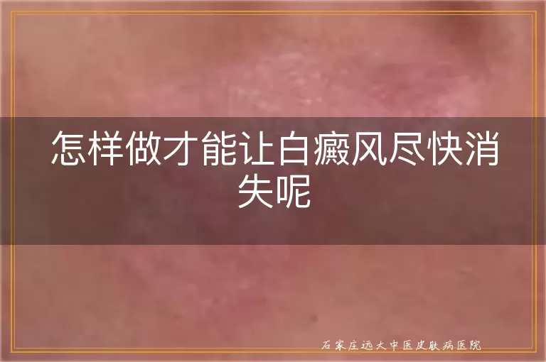 怎样做才能让白癜风尽快消失呢