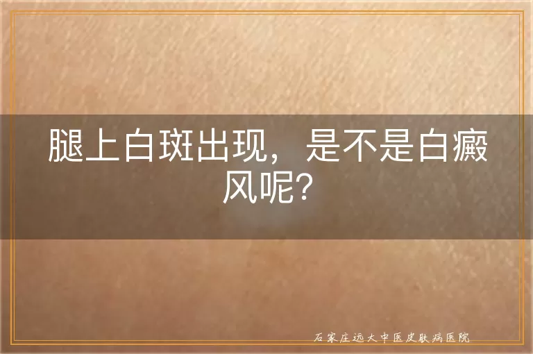 腿上白斑出现，是不是白癜风呢？