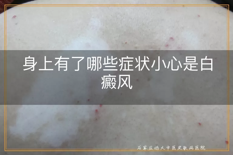 身上有了哪些症状小心是白癜风