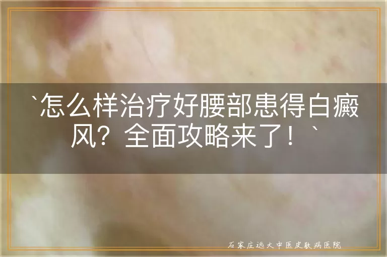 怎么样治疗好腰部患得白癜风？全面攻略来了！