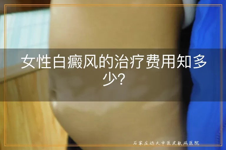 女性白癜风的治疗费用知多少？