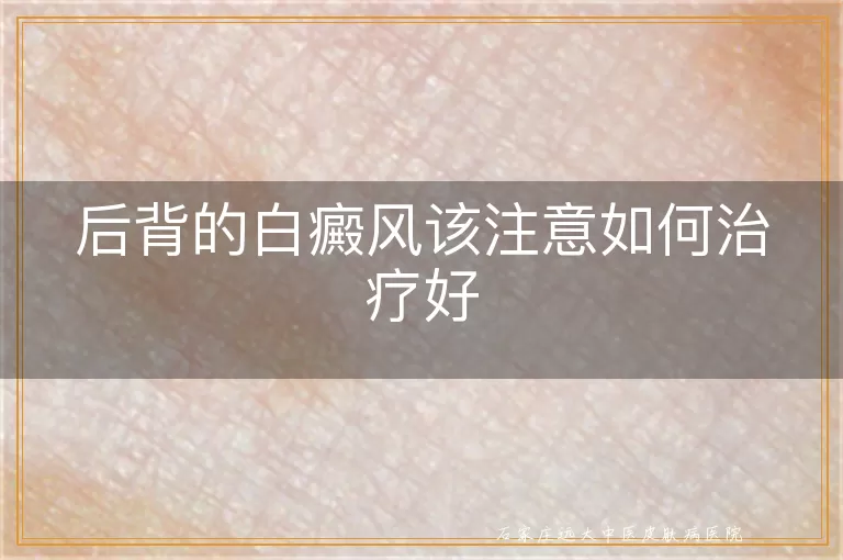 后背的白癜风该注意如何治疗好