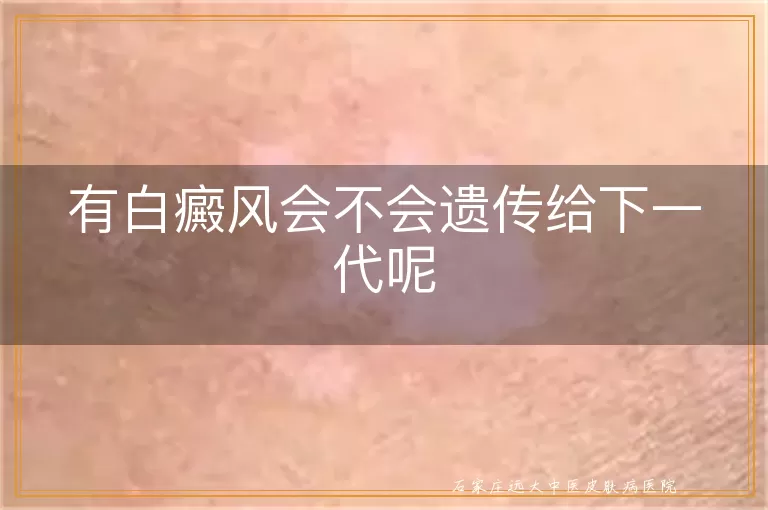 有白癜风会不会遗传给下一代呢