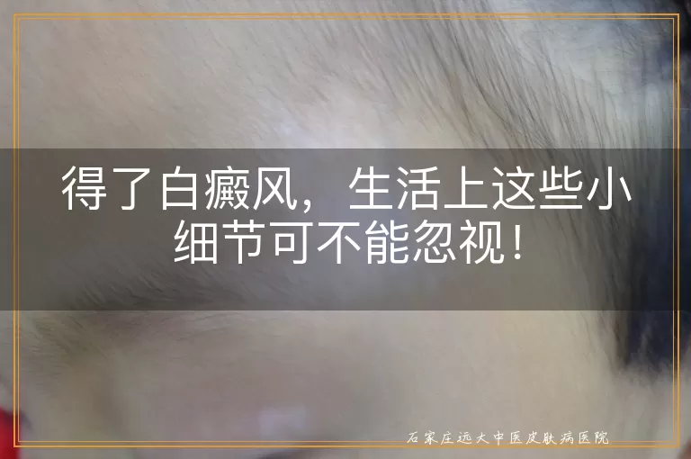 得了白癜风，生活上这些小细节可不能忽视！