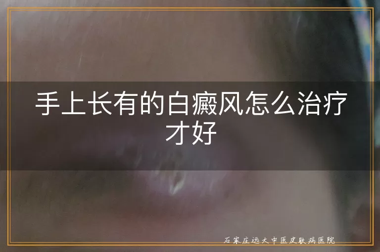 手上长有的白癜风怎么治疗才好