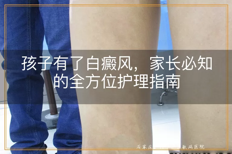 孩子有了白癜风，家长必知的全方位护理指南