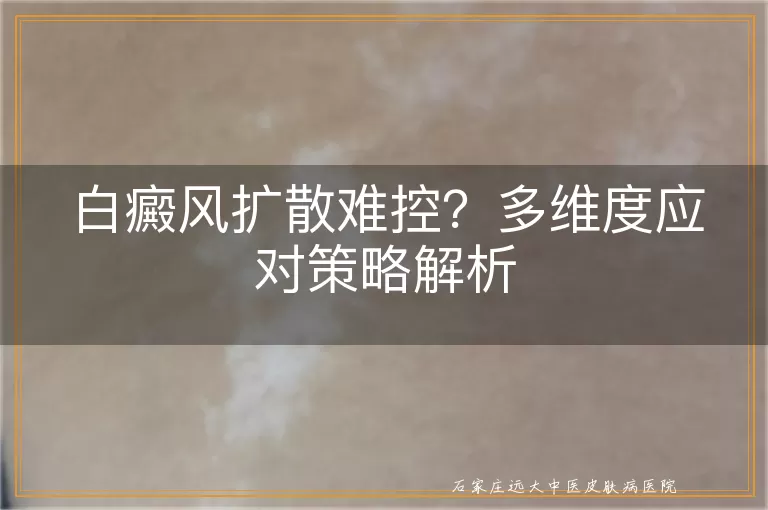 白癜风扩散难控？多维度应对策略解析