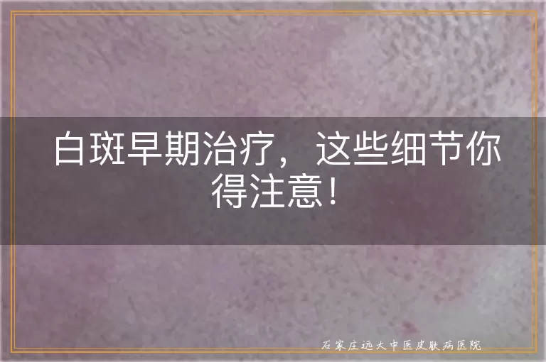白斑早期治疗，这些细节你得注意！