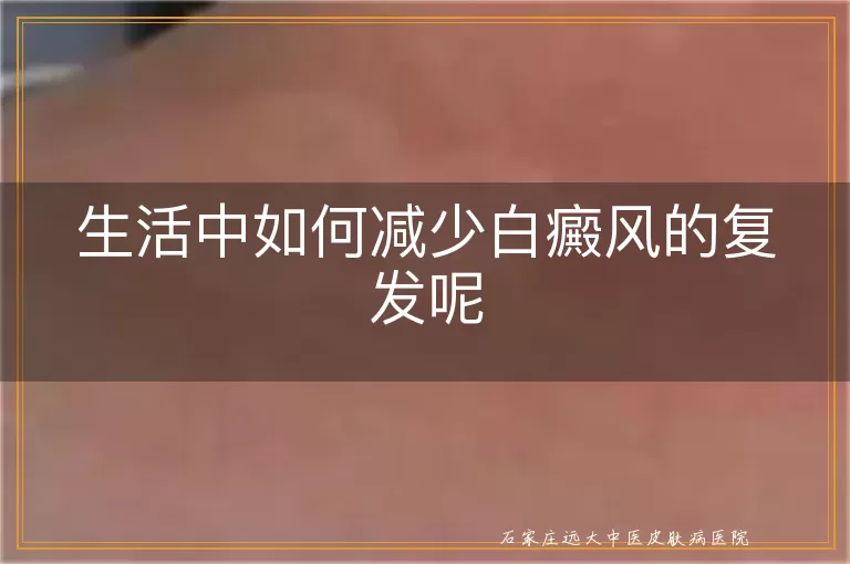 生活中如何减少白癜风的复发呢
