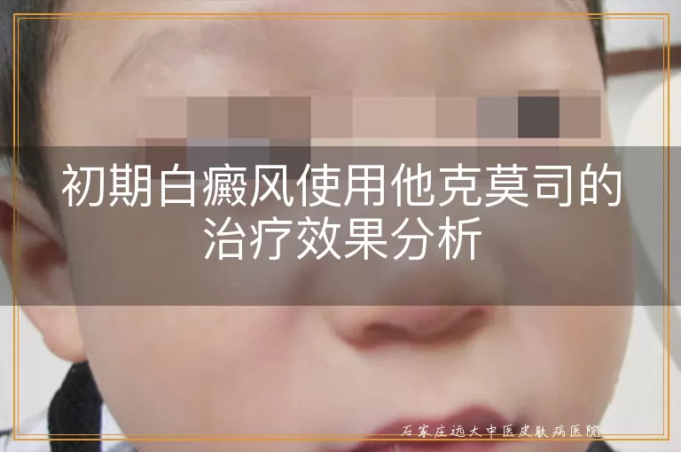 初期白癜风使用他克莫司的治疗效果分析