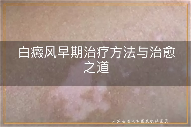 白癜风早期治疗方法与治愈之道